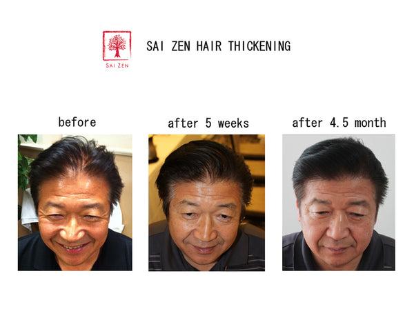 4.5 months usage of Sai Zen Hair Thickening Products