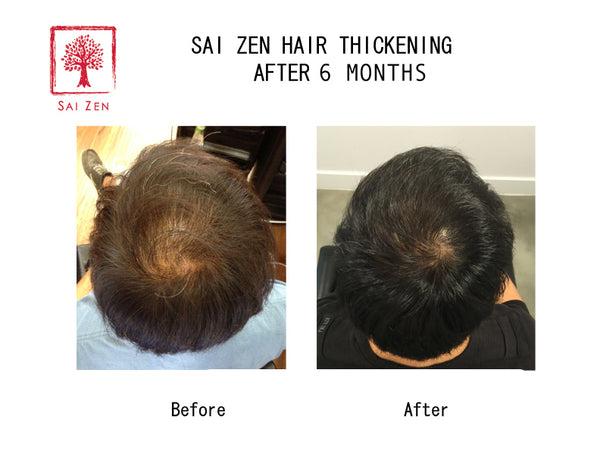 6 months usage of Sai Zen Hair Thickening Products